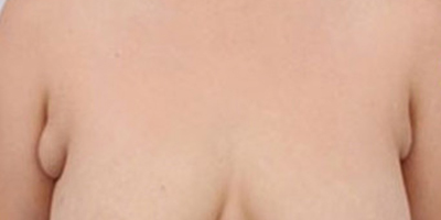 手術(shù)去副乳術(shù)前