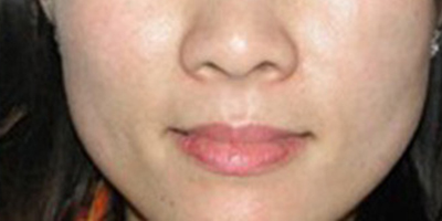 鐳射凈膚術(shù)后