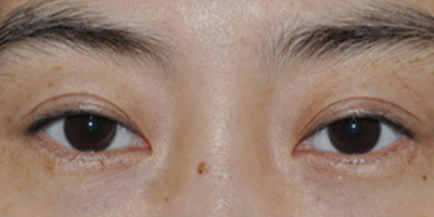 眼部修復術前