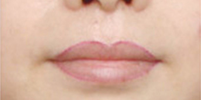 洗唇線術(shù)前