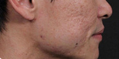 點(diǎn)陣激光術(shù)前