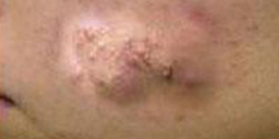 脂肪填充失敗修復(fù)術(shù)前