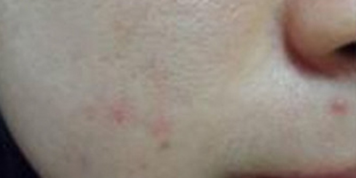 水楊酸煥膚術前