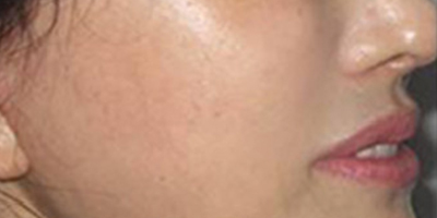 自體脂肪去法令紋術后