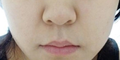 白瓷娃娃術(shù)后