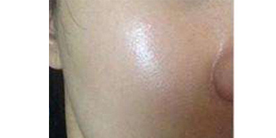 無(wú)針?biāo)庑g(shù)后