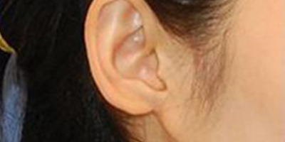 自體脂肪豐耳垂術(shù)前