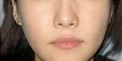 自體脂肪全臉填充術后