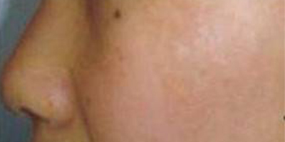 手術(shù)去胎記術(shù)后