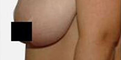 乳房下垂矯正術(shù)前