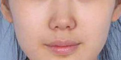 自體脂肪豐鼻基底術(shù)后