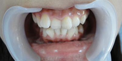 牙齒綜合術(shù)前