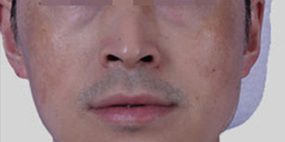 M22王者之冠術(shù)前