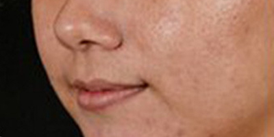 像素激光術(shù)前