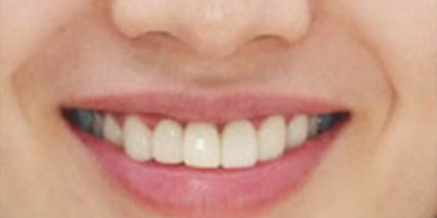 種植牙術(shù)后