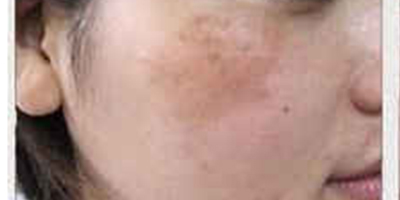 IPL美膚術(shù)前