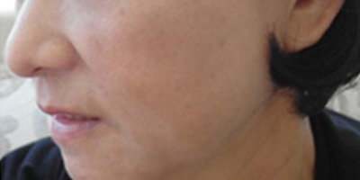 注射去木偶紋術(shù)后