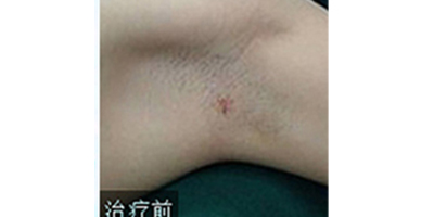 注射去狐臭術(shù)前