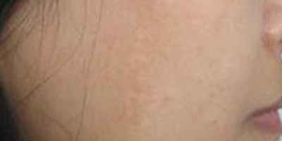 激光祛疤術(shù)后