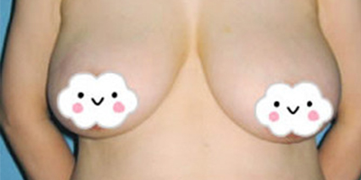 女性乳房縮小術(shù)前