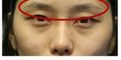 自體脂肪豐眉弓術(shù)前