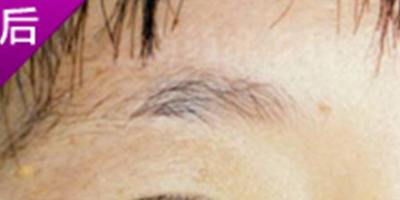 洗眉術(shù)后