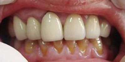 合金烤瓷牙術前