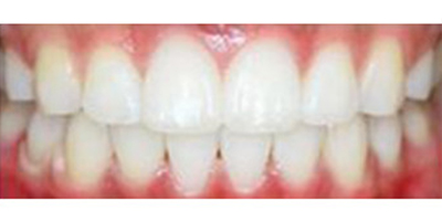 噴砂洗牙術(shù)后