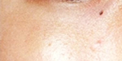 皮秒激光術(shù)后