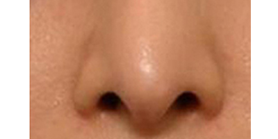 鼻部膨體假體取出術(shù)后