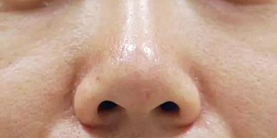 小棕瓶美白術(shù)后