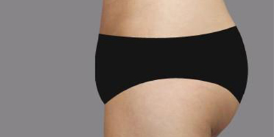 自體脂肪豐臀術后