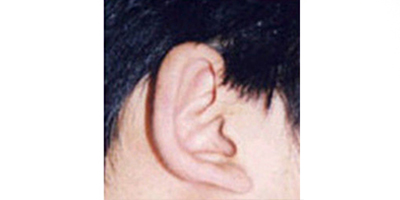 杯狀耳矯正術前