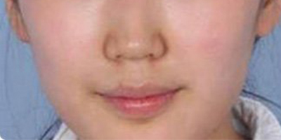 自體脂肪豐鼻基底術(shù)前