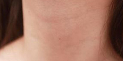 嗨體去頸紋術(shù)前