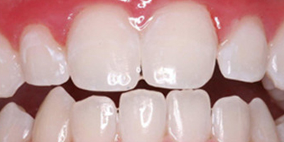 皓齒美白術(shù)后