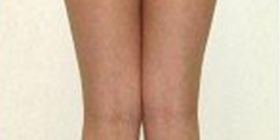 吸脂失敗修復(fù)術(shù)后