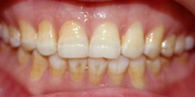 樹脂貼面術(shù)前