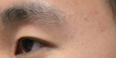 杏仁酸煥膚術后