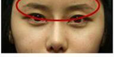 自體脂肪豐眉弓術(shù)后