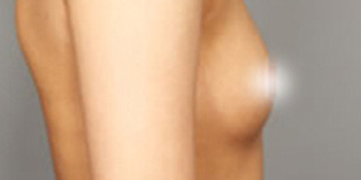 復(fù)合隆胸術(shù)前