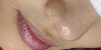 超微小氣泡術(shù)前