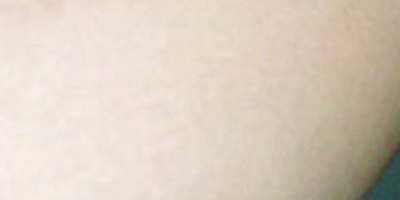 無創(chuàng)疤痕修復(fù)術(shù)后