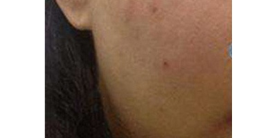 無(wú)針?biāo)庑g(shù)前