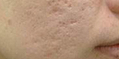 微針美塑術(shù)前