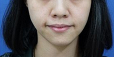 童顏針術(shù)前