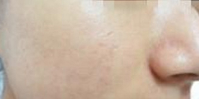 水楊酸煥膚術后