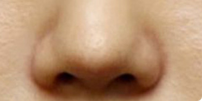 鼻部修復(fù)術(shù)后