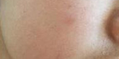 水光補水術(shù)前