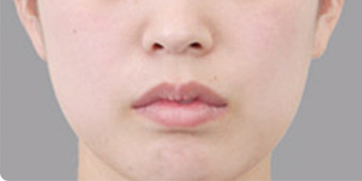 脂肪填充失敗修復(fù)術(shù)前